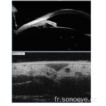 Microscope à ultrasons biomicroscopie pour les yeux